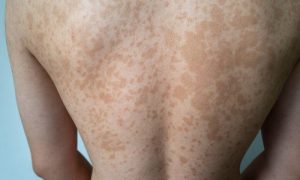 Banish Tinea Versicolor with the Right Diet